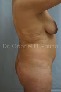  Before and After Cosmetic Surgery in Oakland, CA 