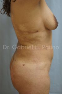  Before and After Cosmetic Surgery in Oakland, CA 