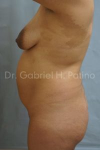  Before and After Cosmetic Surgery in Oakland, CA 