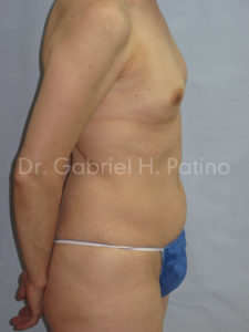  Before and After Cosmetic Surgery in Oakland, CA 