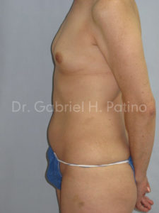  Before and After Cosmetic Surgery in Oakland, CA 