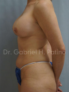  Before and After Cosmetic Surgery in Oakland, CA 