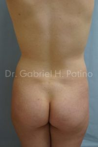  Before and After Cosmetic Surgery in Oakland, CA 