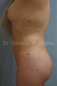  Before and After Cosmetic Surgery in Oakland, CA 