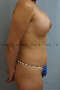  Before and After Cosmetic Surgery in Oakland, CA 