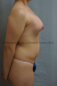  Before and After Cosmetic Surgery in Oakland, CA 