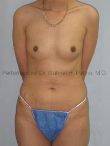  Before and After Cosmetic Surgery in Oakland, CA 