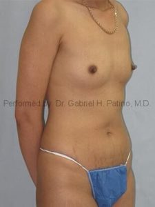  Before and After Cosmetic Surgery in Oakland, CA 