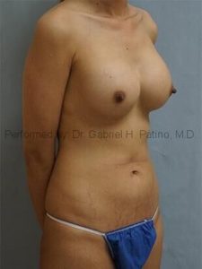  Before and After Cosmetic Surgery in Oakland, CA 