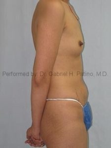  Before and After Cosmetic Surgery in Oakland, CA 