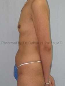  Before and After Cosmetic Surgery in Oakland, CA 