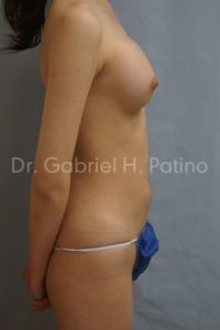  Before and After Cosmetic Surgery in Oakland, CA 