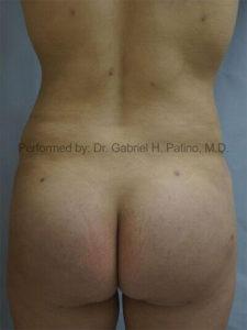  Before and After Cosmetic Surgery in Oakland, CA 