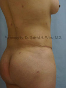  Before and After Cosmetic Surgery in Oakland, CA 