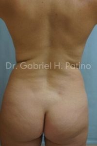  Before and After Cosmetic Surgery in Oakland, CA 