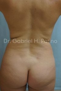  Before and After Cosmetic Surgery in Oakland, CA 