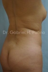  Before and After Cosmetic Surgery in Oakland, CA 