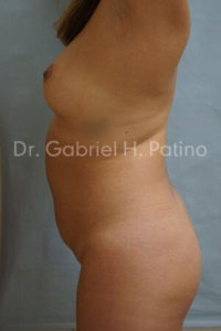  Before and After Cosmetic Surgery in Oakland, CA 