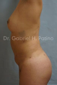  Before and After Cosmetic Surgery in Oakland, CA 