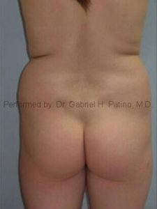  Before and After Cosmetic Surgery in Oakland, CA 