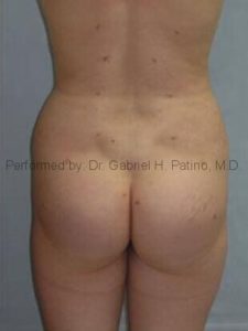  Before and After Cosmetic Surgery in Oakland, CA 