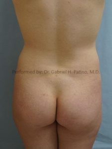  Before and After Cosmetic Surgery in Oakland, CA 