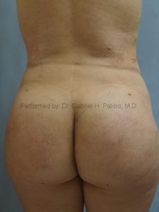  Before and After Cosmetic Surgery in Oakland, CA 