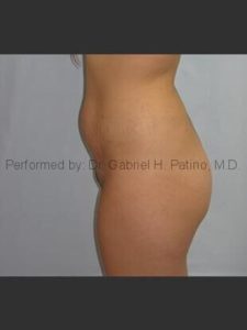  Before and After Cosmetic Surgery in Oakland, CA 