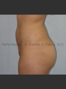  Before and After Cosmetic Surgery in Oakland, CA 