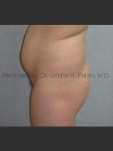  Before and After Cosmetic Surgery in Oakland, CA 