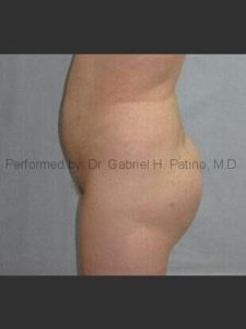  Before and After Cosmetic Surgery in Oakland, CA 