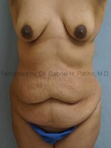  Before and After Cosmetic Surgery in Oakland, CA 