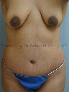  Before and After Cosmetic Surgery in Oakland, CA 