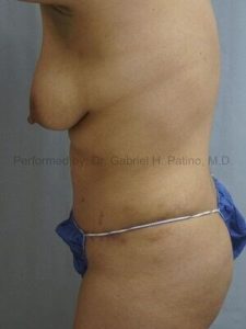  Before and After Cosmetic Surgery in Oakland, CA 