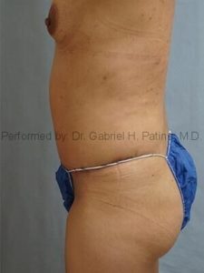  Before and After Cosmetic Surgery in Oakland, CA 