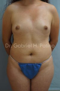  Before and After Cosmetic Surgery in Oakland, CA 