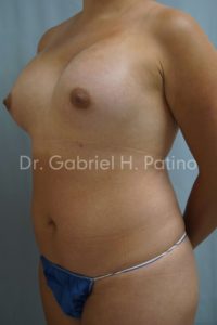  Before and After Cosmetic Surgery in Oakland, CA 