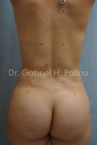  Before and After Cosmetic Surgery in Oakland, CA 