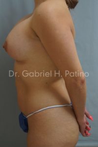  Before and After Cosmetic Surgery in Oakland, CA 