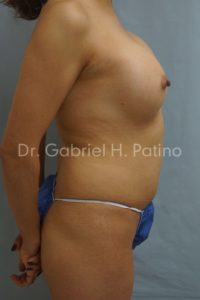  Before and After Cosmetic Surgery in Oakland, CA 