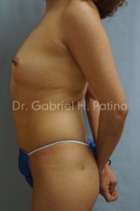  Before and After Cosmetic Surgery in Oakland, CA 