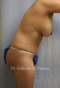  Before and After Cosmetic Surgery in Oakland, CA 