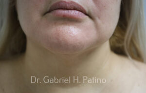  Before and After Cosmetic Surgery in Oakland, CA 