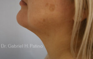  Before and After Cosmetic Surgery in Oakland, CA 