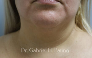  Before and After Cosmetic Surgery in Oakland, CA 