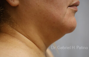  Before and After Cosmetic Surgery in Oakland, CA 