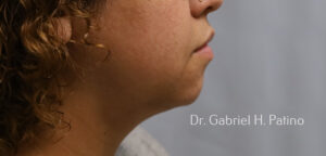  Before and After Cosmetic Surgery in Oakland, CA 