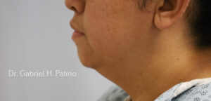  Before and After Cosmetic Surgery in Oakland, CA 