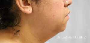  Before and After Cosmetic Surgery in Oakland, CA 