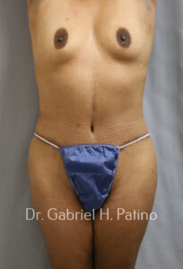  Before and After Cosmetic Surgery in Oakland, CA 